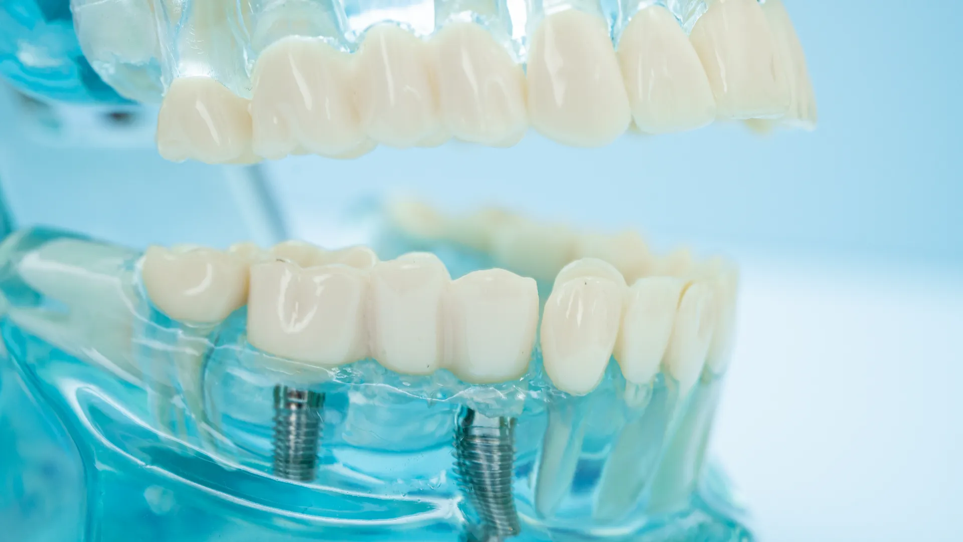 دورة زراعة الأسنان في اسطنبول